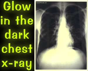 Glow-in-the-dark chest x-ray